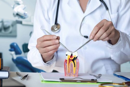Showing a Model of a Damaged Tooth in a Dental Office, need for root canal therapy