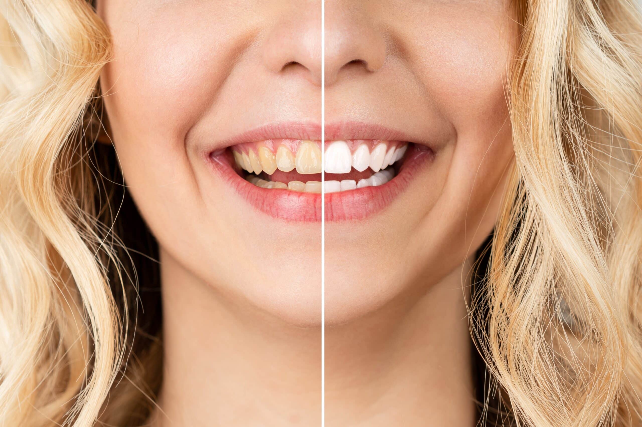 before and after of a cosmetic dental procedure in Ocala