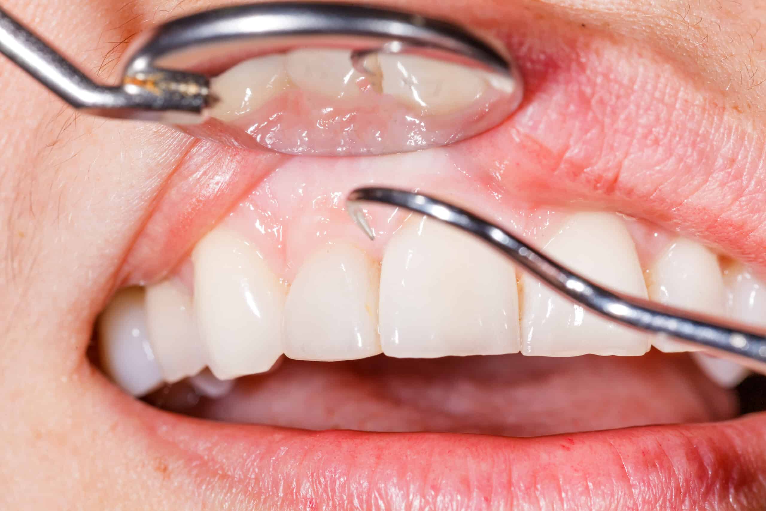doctor examining a patients gums, looking for early signs of gum disease