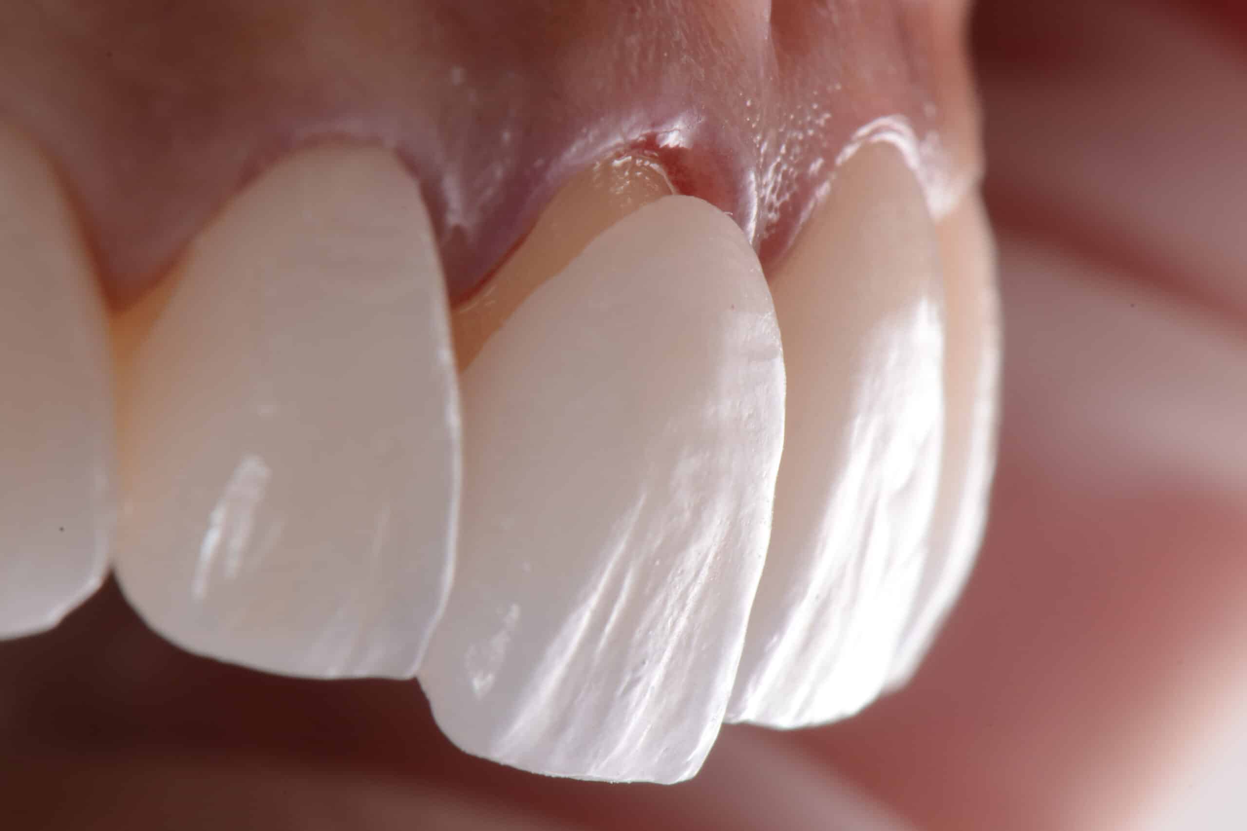 Placing porcelain laminated veneers for smile makeover treatment