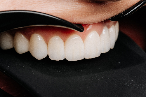 closeup application of dental veneers